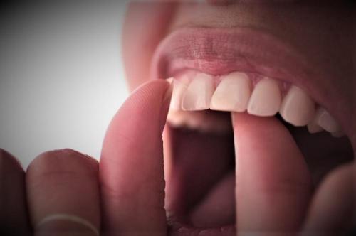 ČIŠČENJE ZOBNEGA KAMNA VIČ | ZOBNA HIGIENA BARBARA MARKIČ, LJUBLJANA